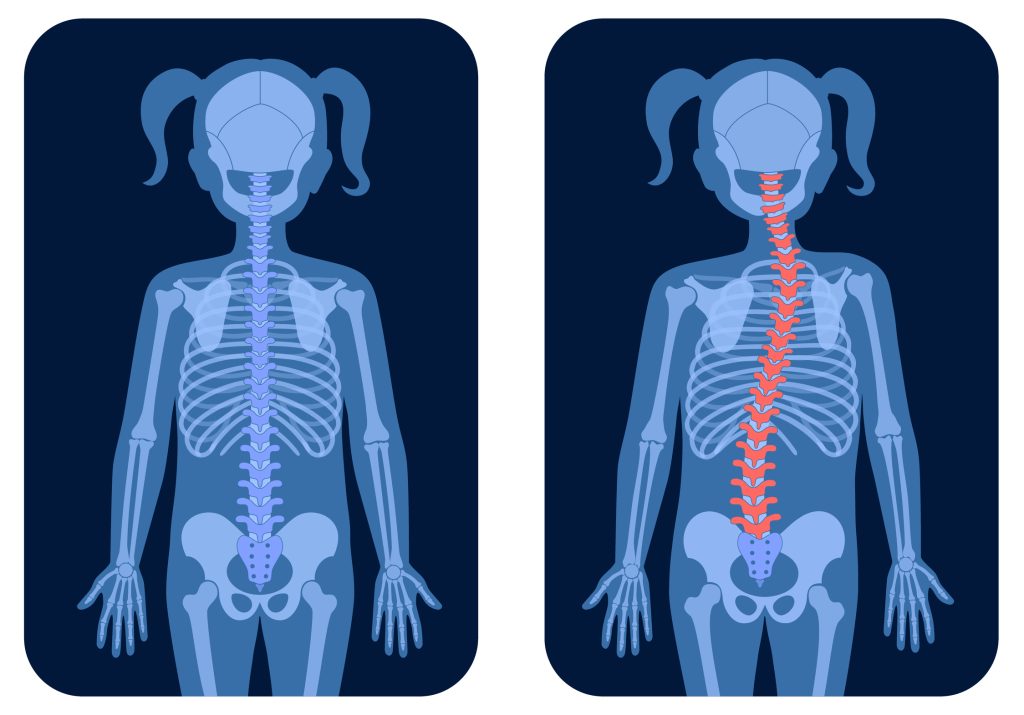 Illustration showing the effects of scoliosis on the spine before and after corrective surgery
