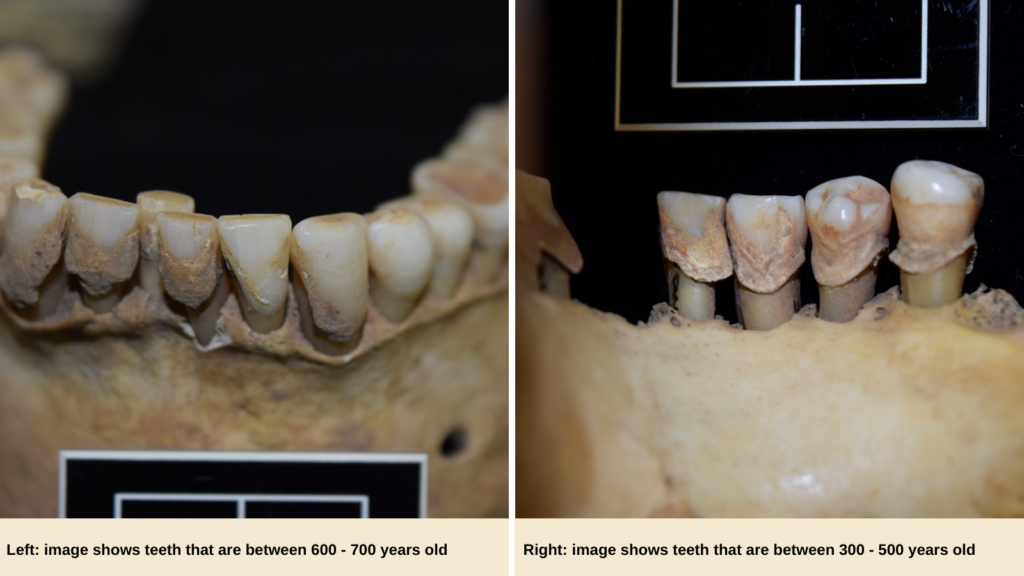 Left image shows teeth that are between 600-700 years old. Right image shows teeth that are between 300-500 years old