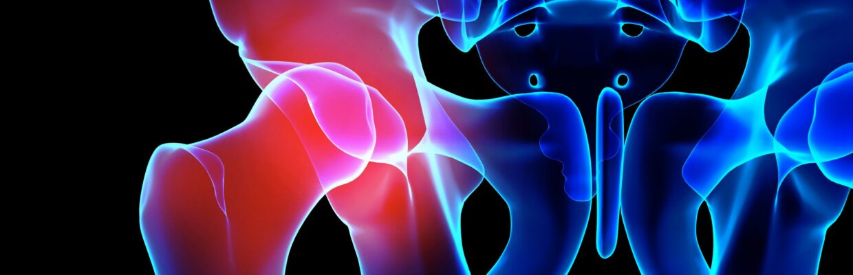 Hip replacement