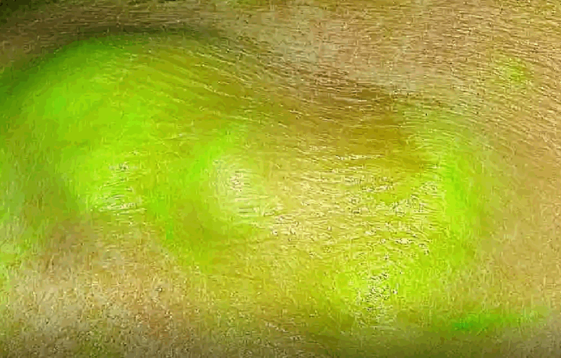 The green dye gathers round the sarcoma under the skin