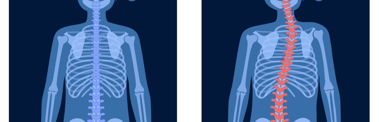 Illustration showing the effects of scoliosis on the spine before and after corrective surgery